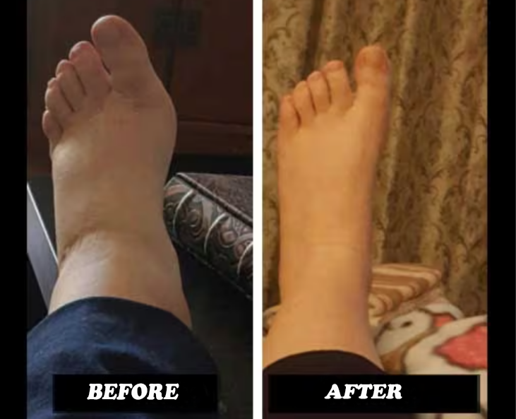 before and after leg swelling