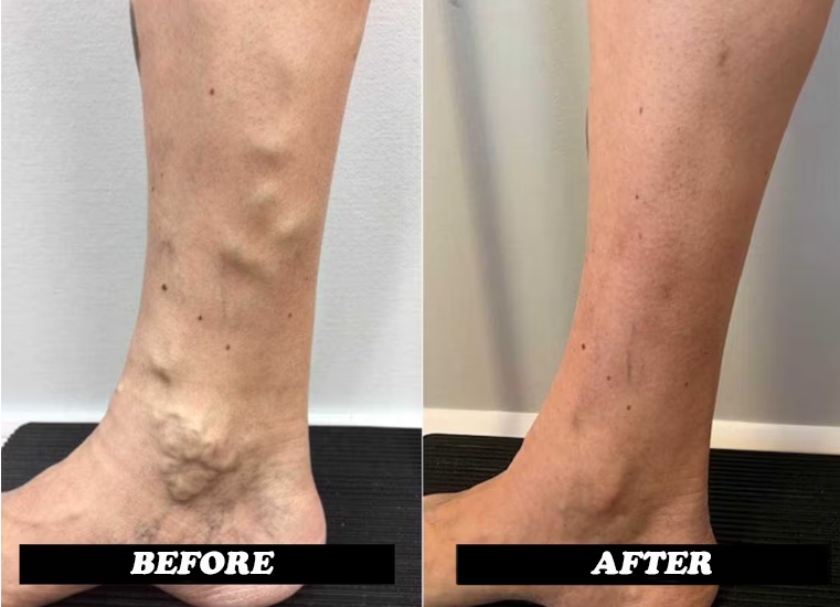 before and after leg swelling